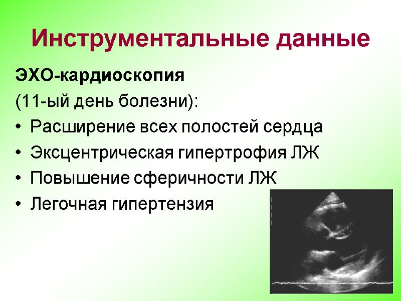 Инструментальные данные ЭХО-кардиоскопия  (11-ый день болезни):  Расширение всех полостей сердца Эксцентрическая гипертрофия